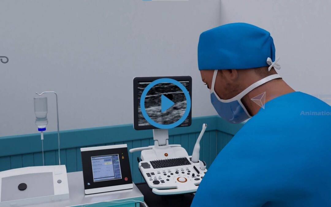 Portfolio: 3D Medical Animated Video of  Varicose Vein Treatment | Medical Animation Services