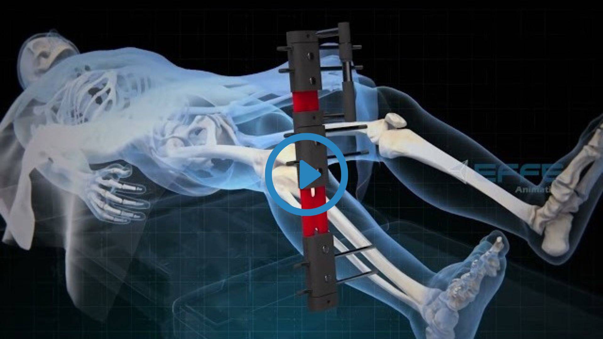 Best 3D Surgery Animation Video of Limb Lengthening