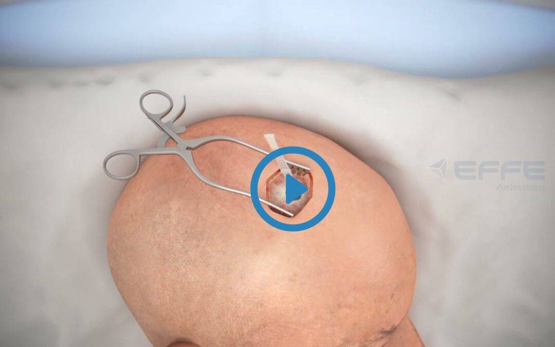 3D Medical Animation Video Brain Surgery | 3D Medical Animation Services