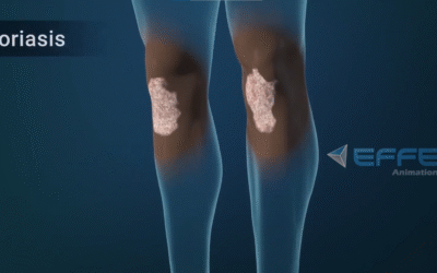 Portfolio: Revolutionizing Dermatology Learning with 3D Mechanism of Disease Animation