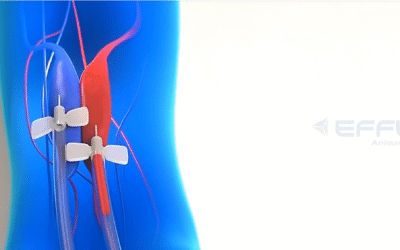 Portfolio: Revolutionizing Nephrology Training with 3D Renal Devices Animation Video
