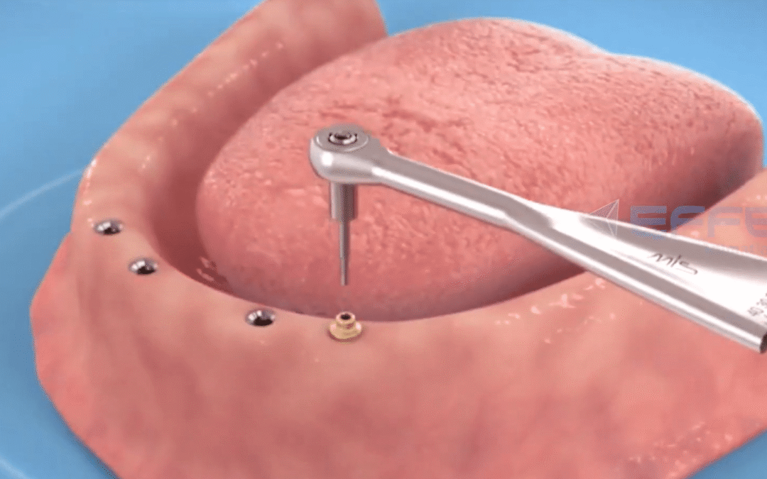 Portfolio: Redefining Dental Education with 3D Medical Devices Animation Video