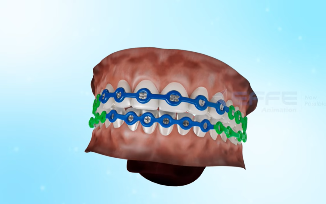 Portfolio: Orthodontic 3D Animation for Elastic Chains | Precision Dental Product Visualization