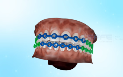 Portfolio: Orthodontic 3D Animation for Elastic Chains | Precision Dental Product Visualization